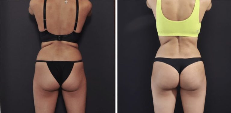 Skinny BBL: A natural approach to buttock enhancement
