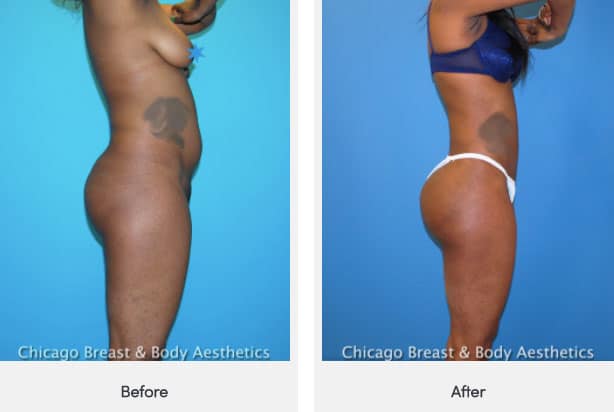 skinny bbl cost skinny bbl cost