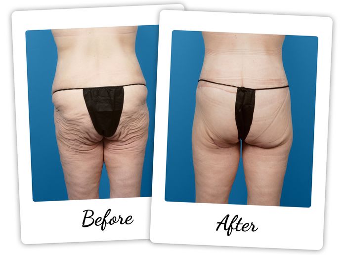 spiral thigh lift spiral thigh lift