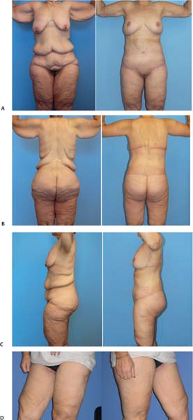 spiral thigh lift spiral thigh lift