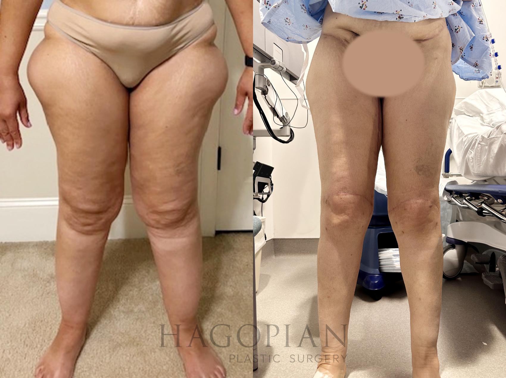 spiral thigh lift spiral thigh lift