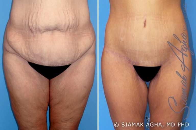 Spiral thigh lift: The latest in leg contouring procedures