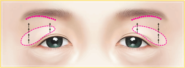 Sub brow lift: Subtle changes for a refreshed look