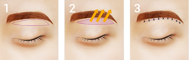 sub brow lift sub brow lift