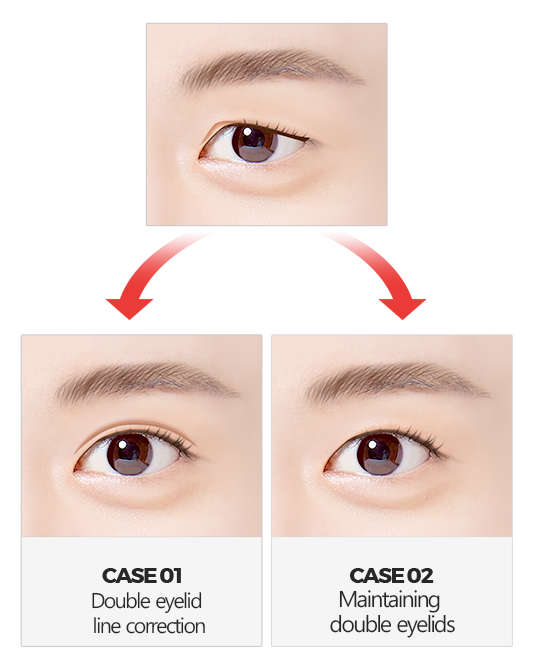 sub brow lift sub brow lift
