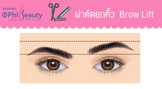 sub brow lift sub brow lift