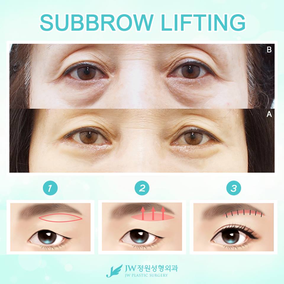 sub brow lift sub brow lift