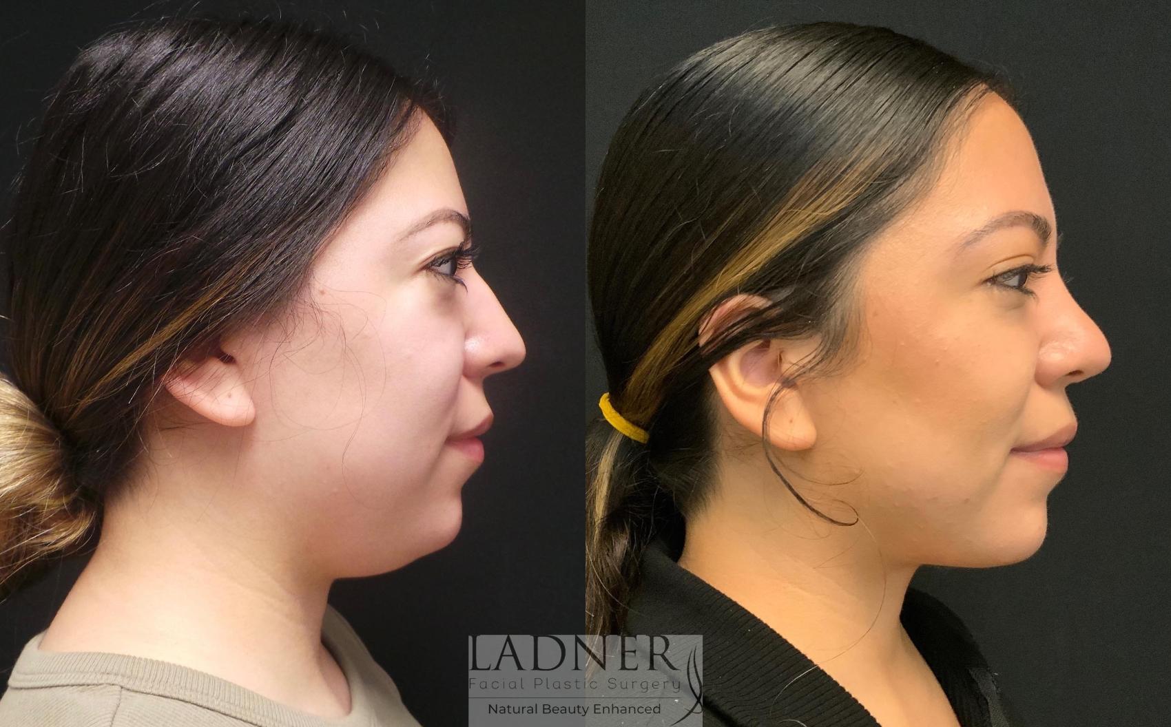 submental lipo submental lipo