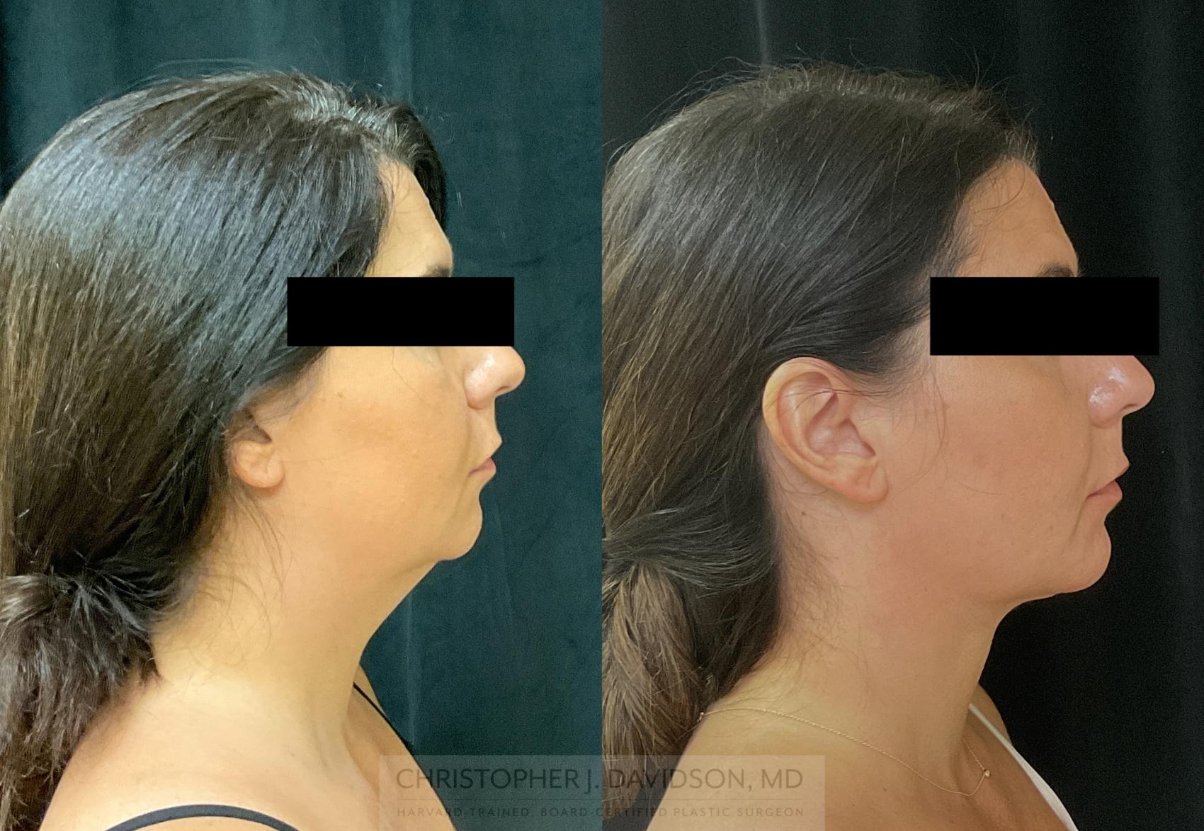 submental lipo submental lipo