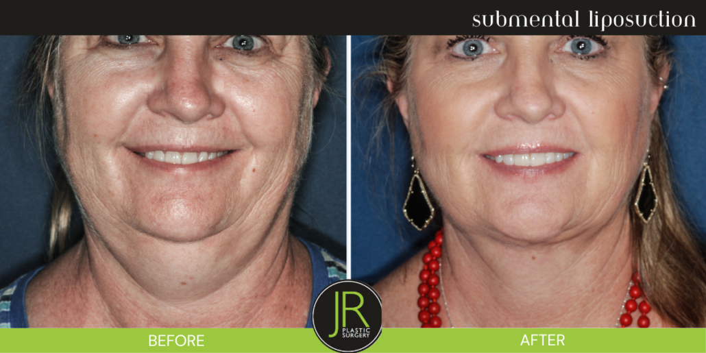 submental lipo submental lipo