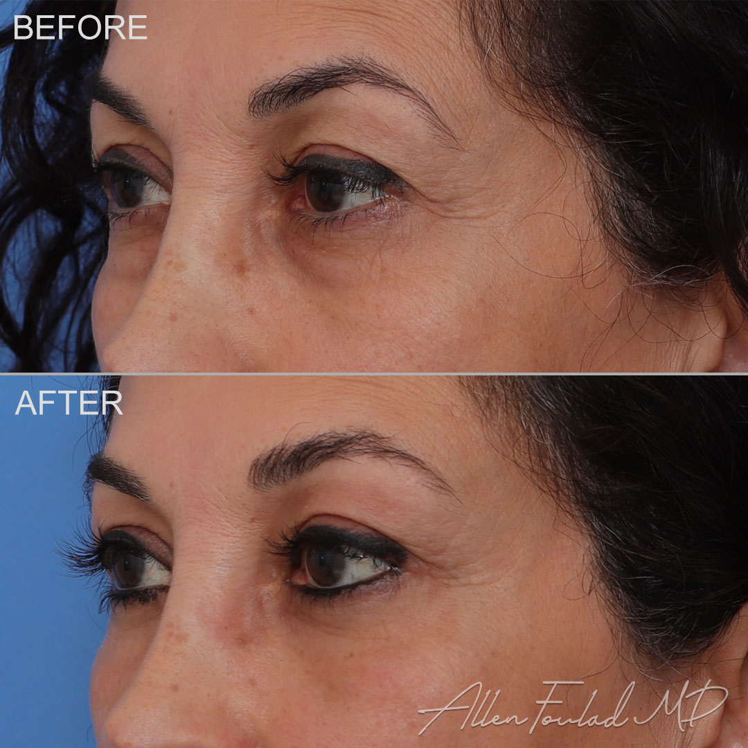 temporal brow lift temporal brow lift