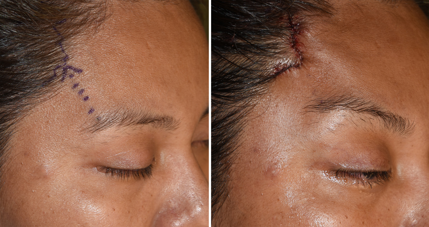 temporal brow lift temporal brow lift