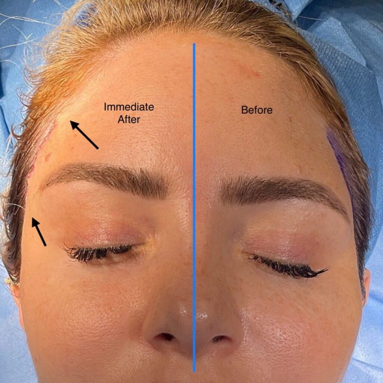Temporal brow lift: A minimally invasive approach to a youthful look
