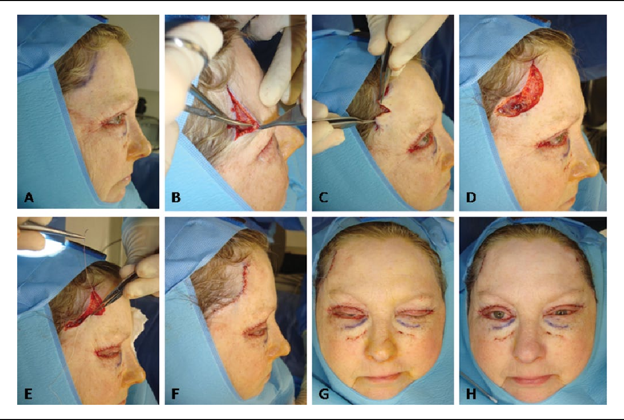 temporal brow lift temporal brow lift