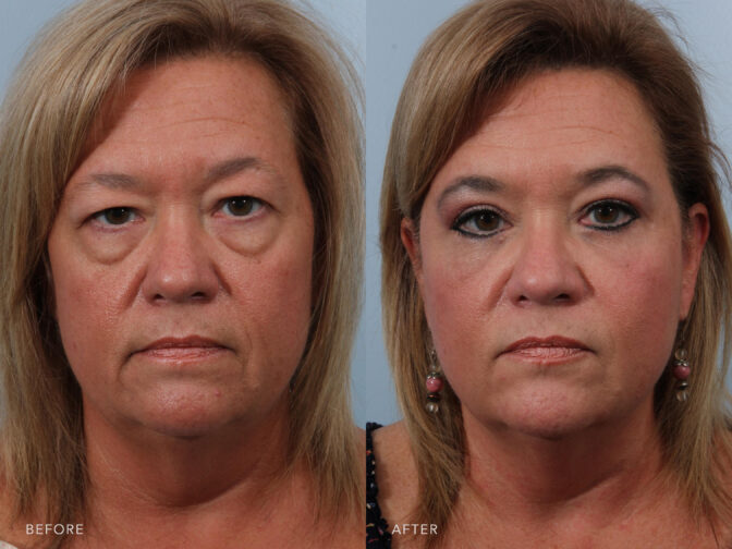 eye lid lift eye lid lift