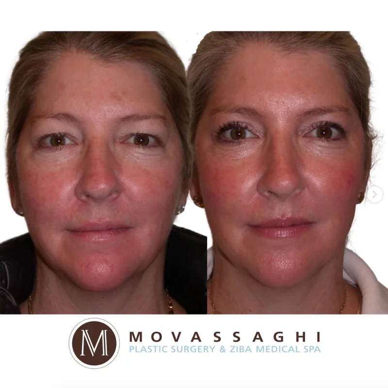 eye lid lift eye lid lift