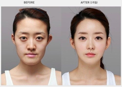 korean plastic surgery korean plastic surgery