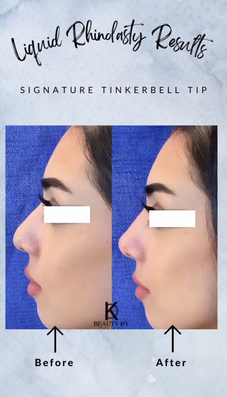 tinkerbell nose lift