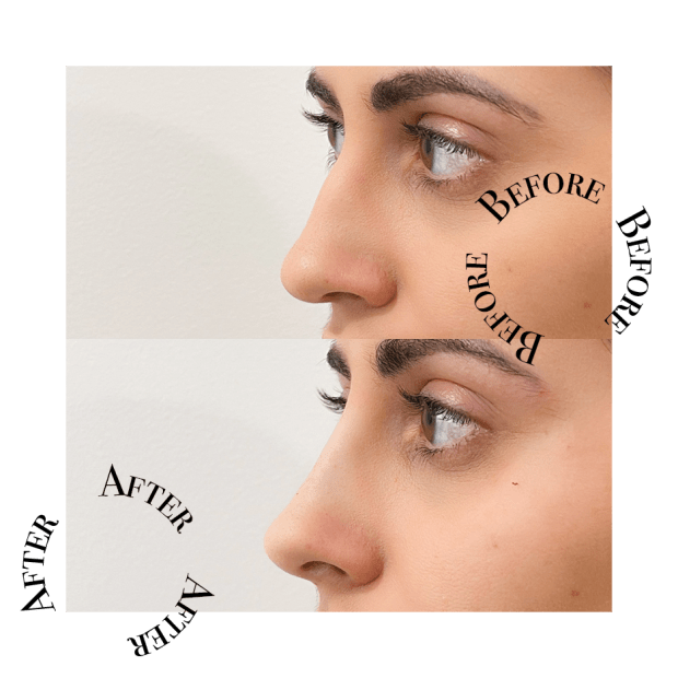 tinkerbell nose lift