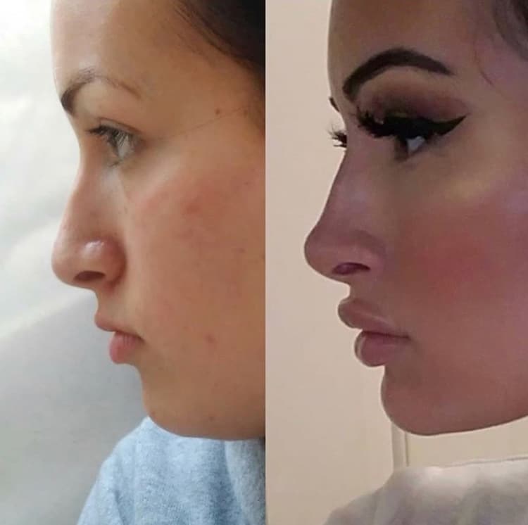 tinkerbell nose lift