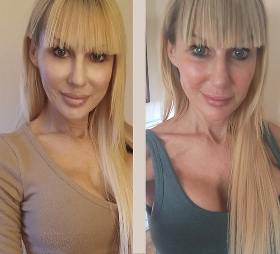 Tinkerbell Nose Lift: Subtle nasal refinement