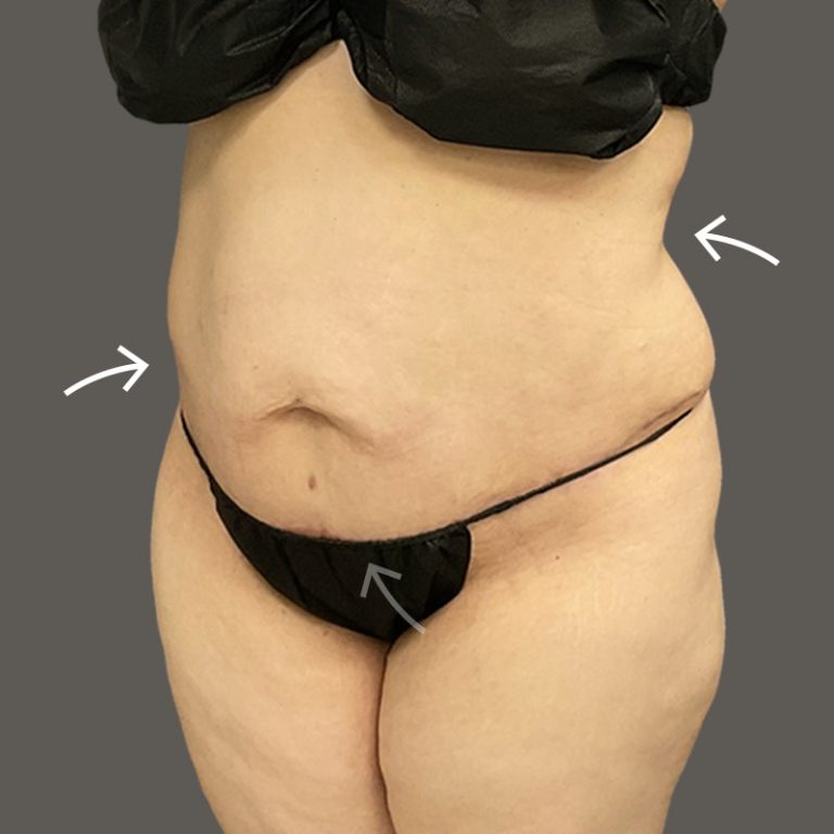 Tiny Tuck: Small adjustments, big results