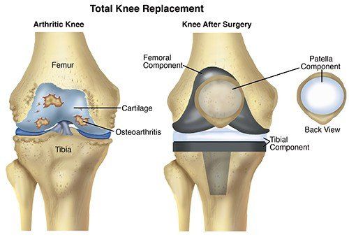 total knee replacement procedure