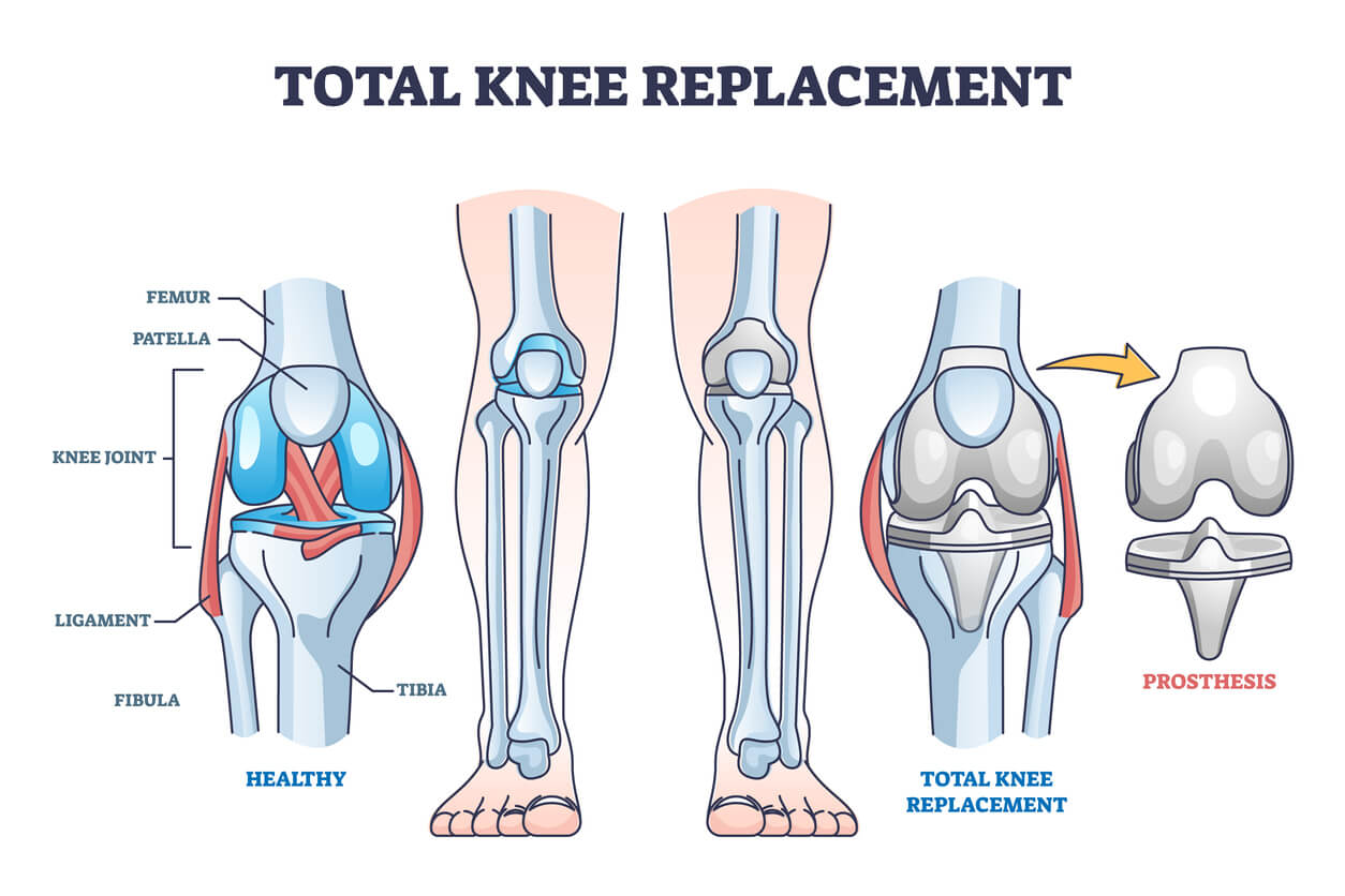 total knee replacement procedure
