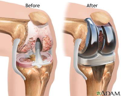 total knee replacement procedure