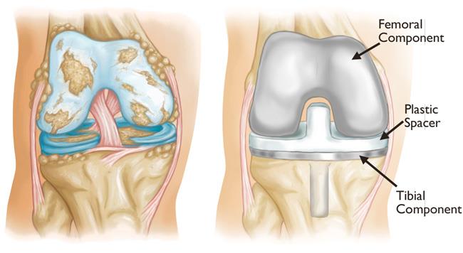 Total knee replacement procedure: What to expect from start to finish