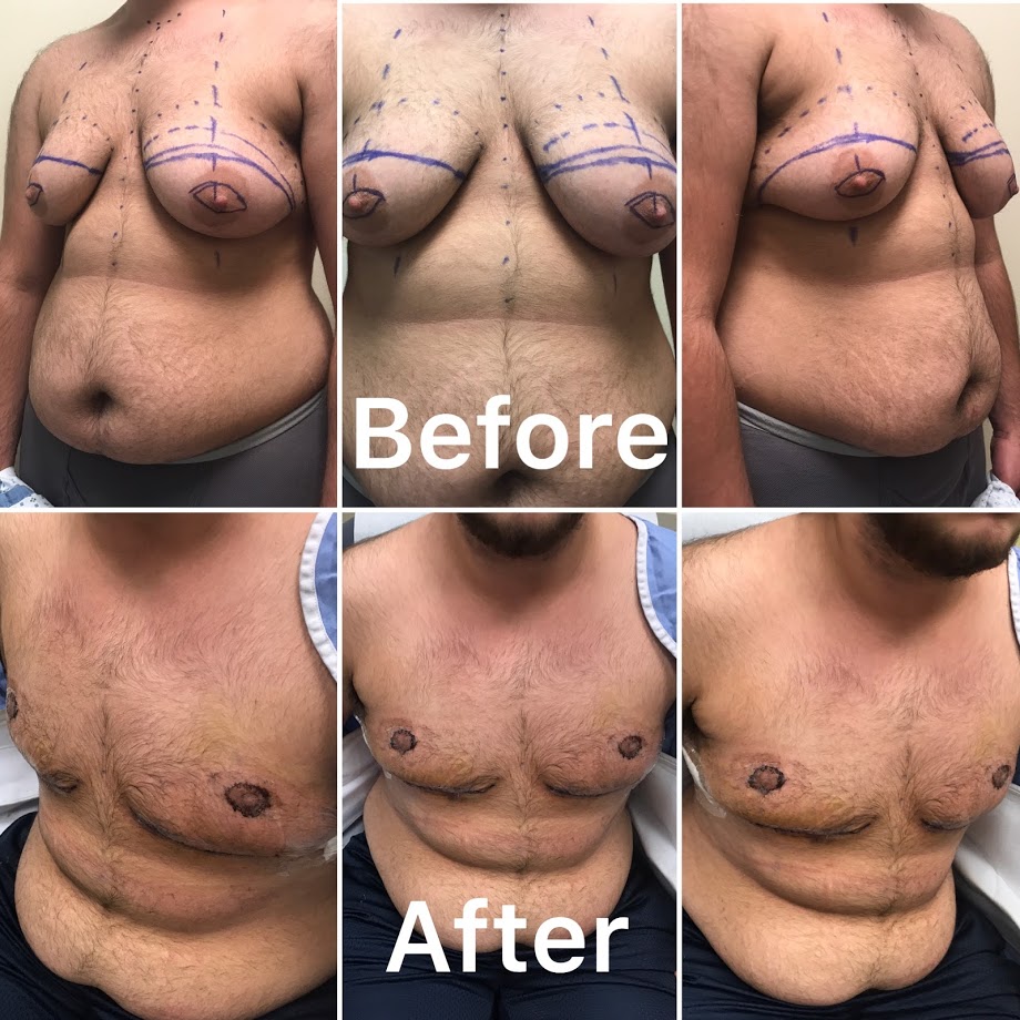 transgender operation