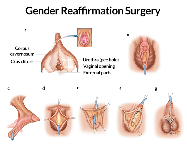 transgender operation