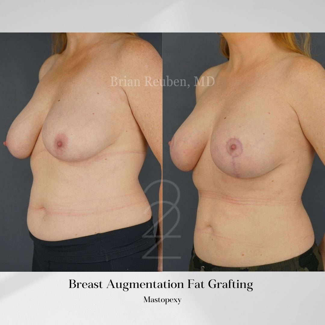 fat breast
