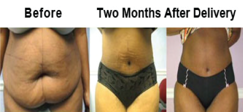 tummy tuck after pregnancy