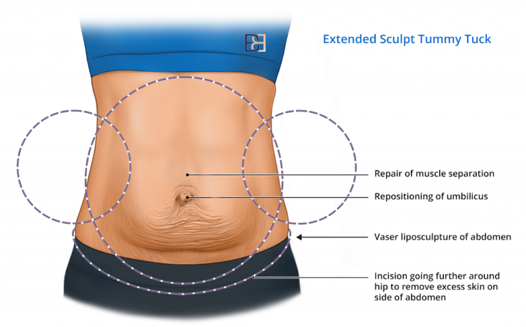 Tummy Tuck After Pregnancy: Restoring your pre-baby body