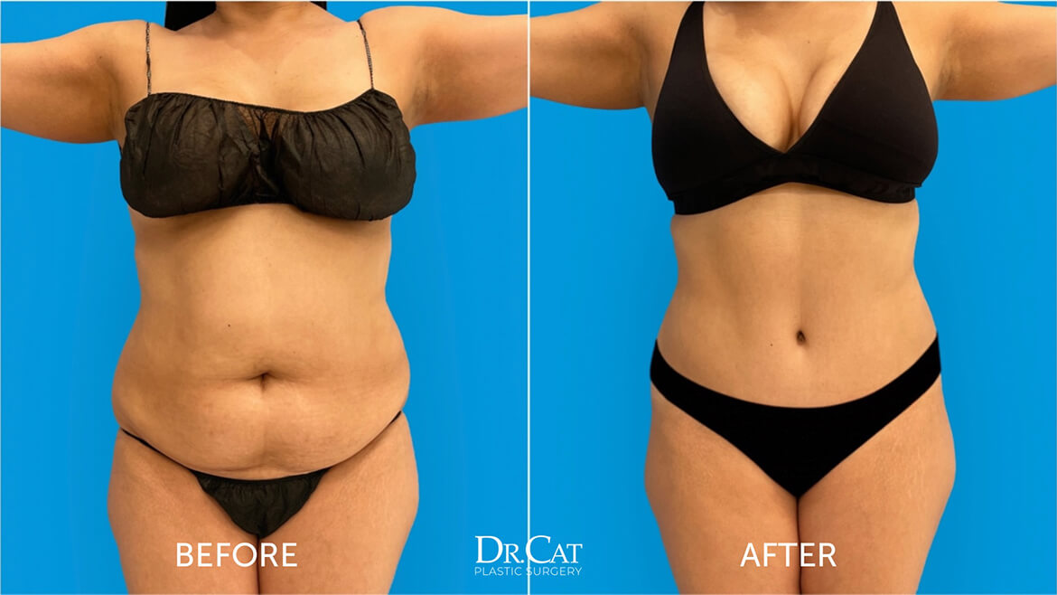 tummy tuck after pregnancy