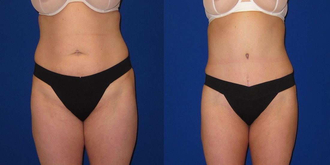 tummy tuck and bbl tummy tuck and bbl