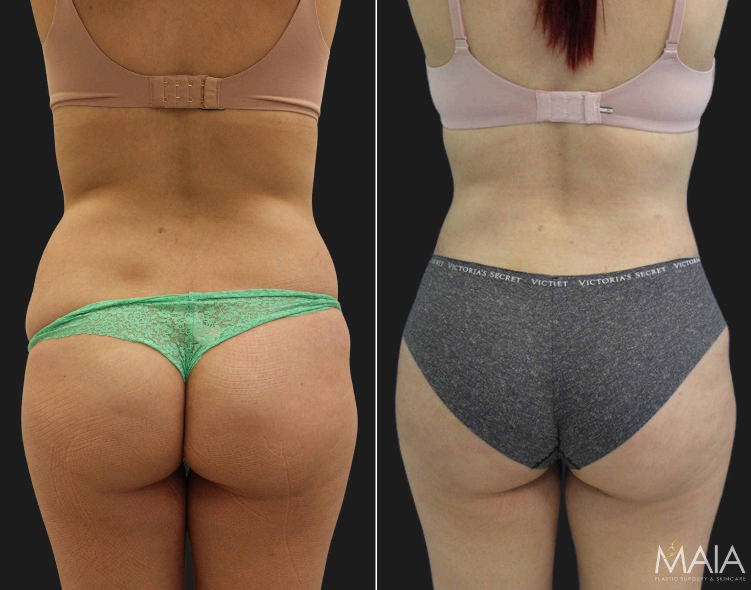 tummy tuck and bbl tummy tuck and bbl
