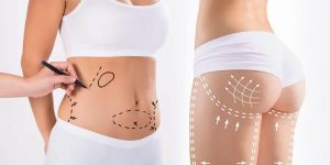 Tummy Tuck and BBL: Combined body contouring