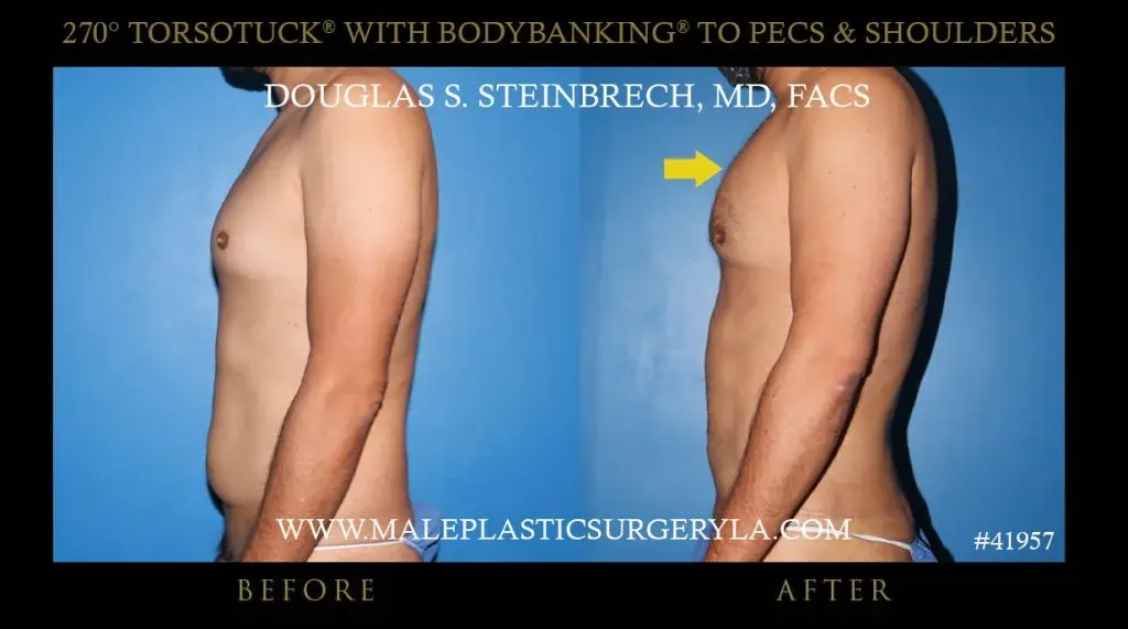 tummy tuck for men tummy tuck for men