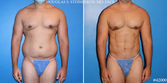 Tummy tuck for men: Sculpting a flatter, firmer abdomen