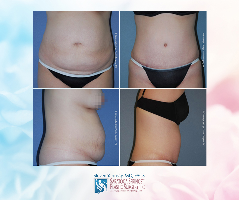tummy tuck price