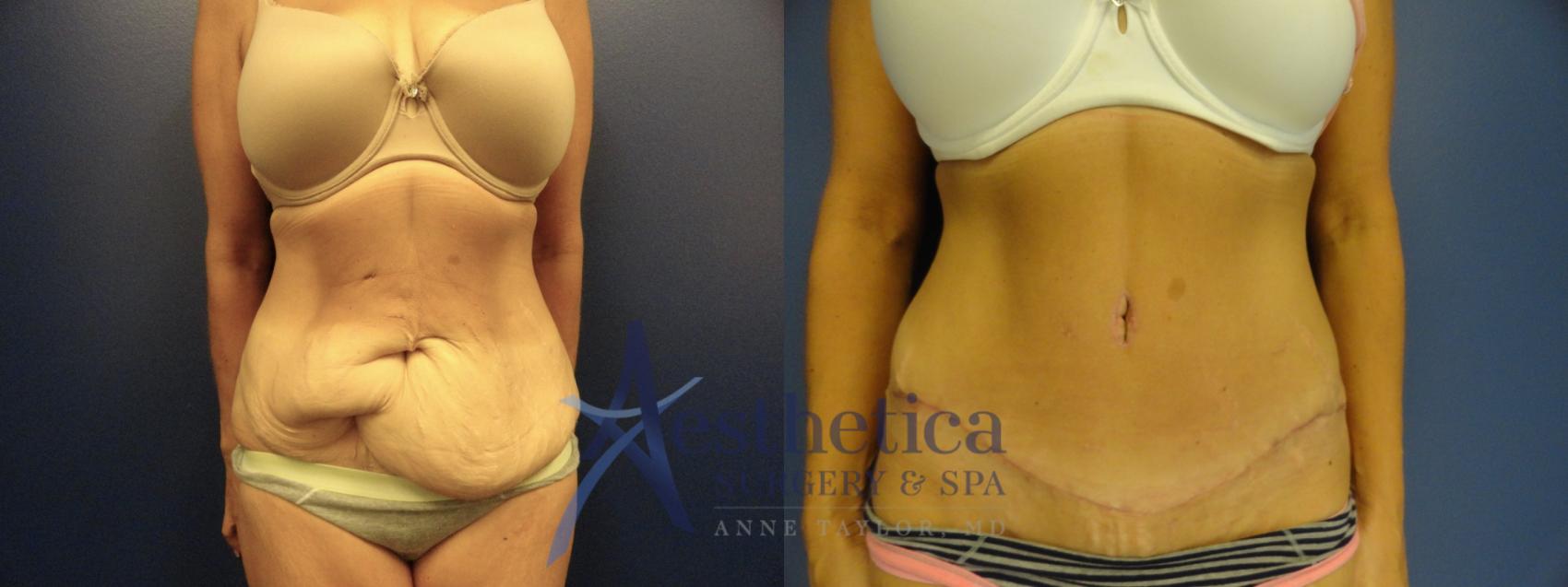 tummy tuck price