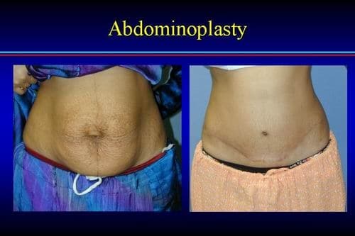 tummy tuck price