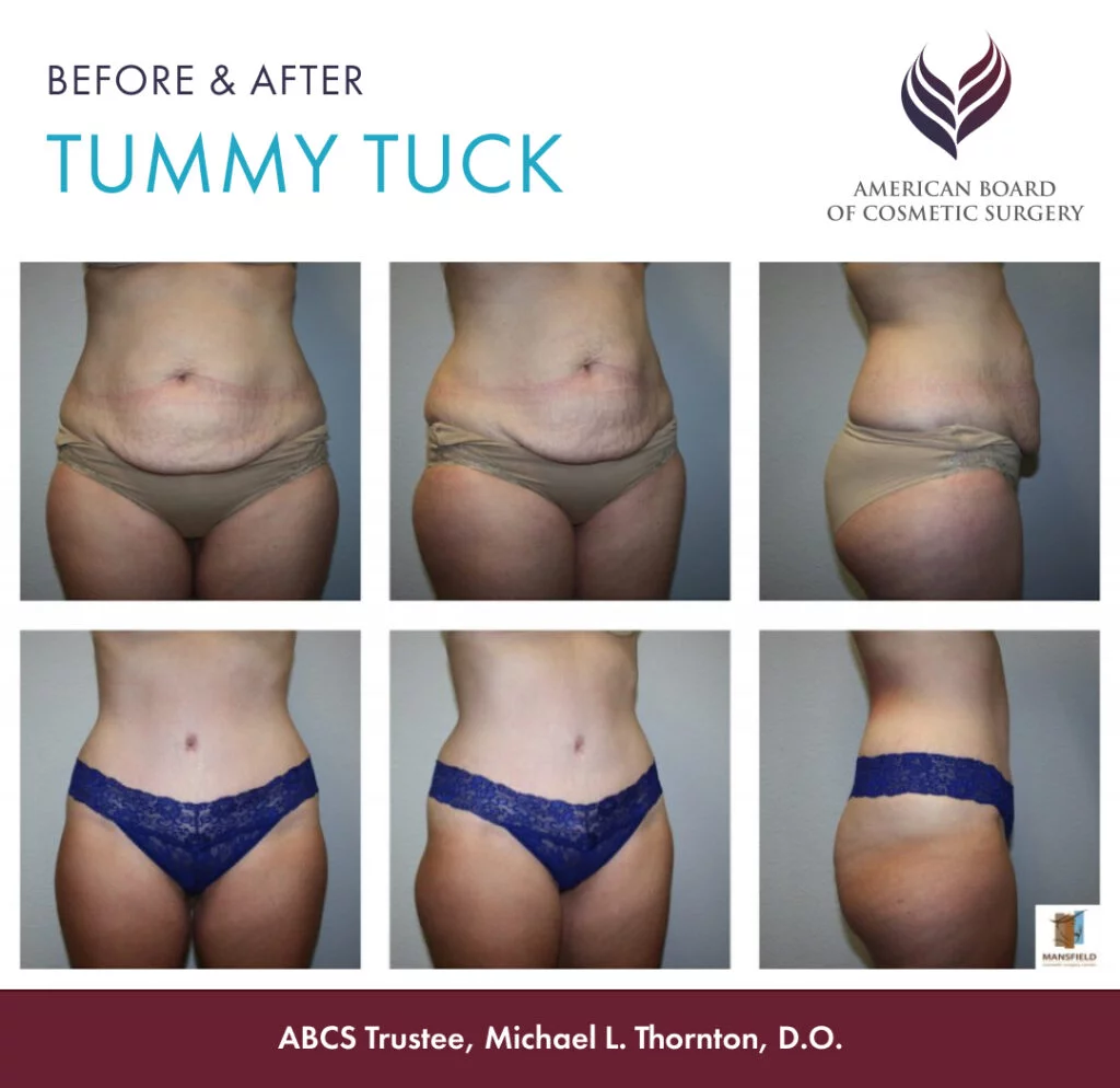 tummy tuck
