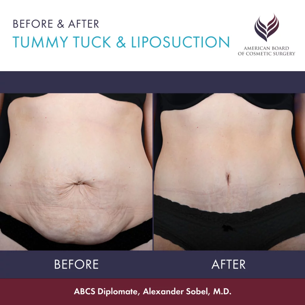 tummy tuck