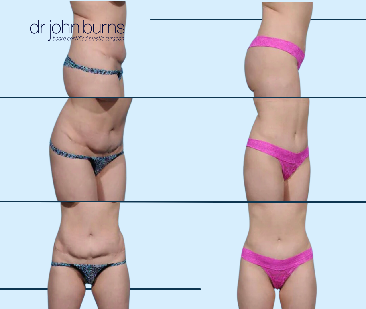 tummy tuck revision