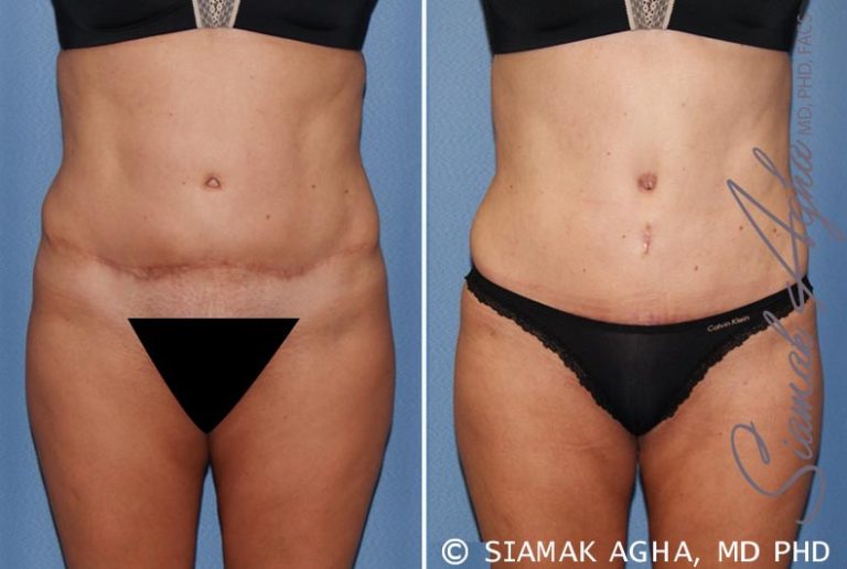 Tummy Tuck Revision: Refining previous results