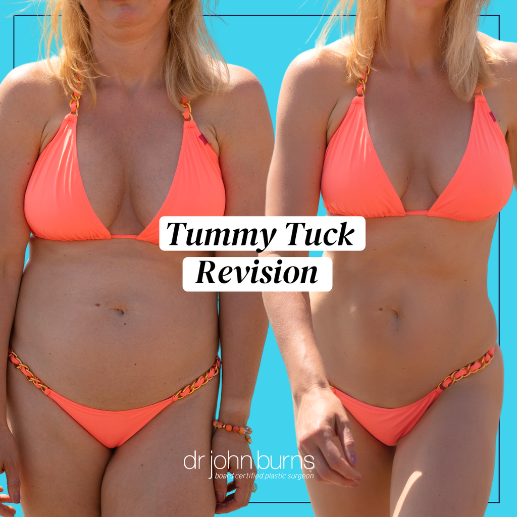 tummy tuck revision