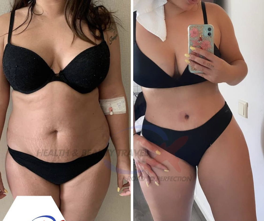 tummy tuck turkey